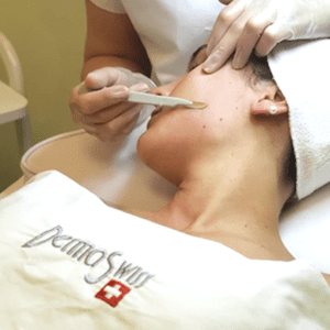 rostro mujer en tratamiento Dermaplaning